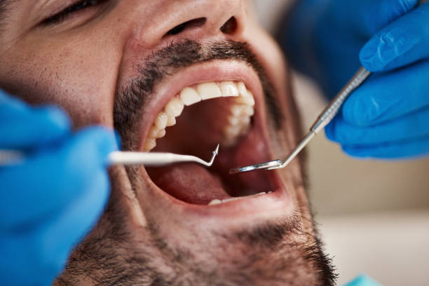 Best Emergency Wisdom Tooth Extraction in Cienega Springs, AZ